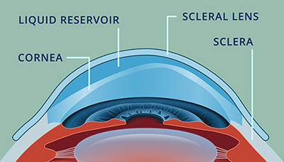 Scleral Contact Lens Sclera Milwaukee WI