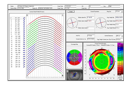 Scleral Contact Lens Fitting Family Vision, Burlington WI